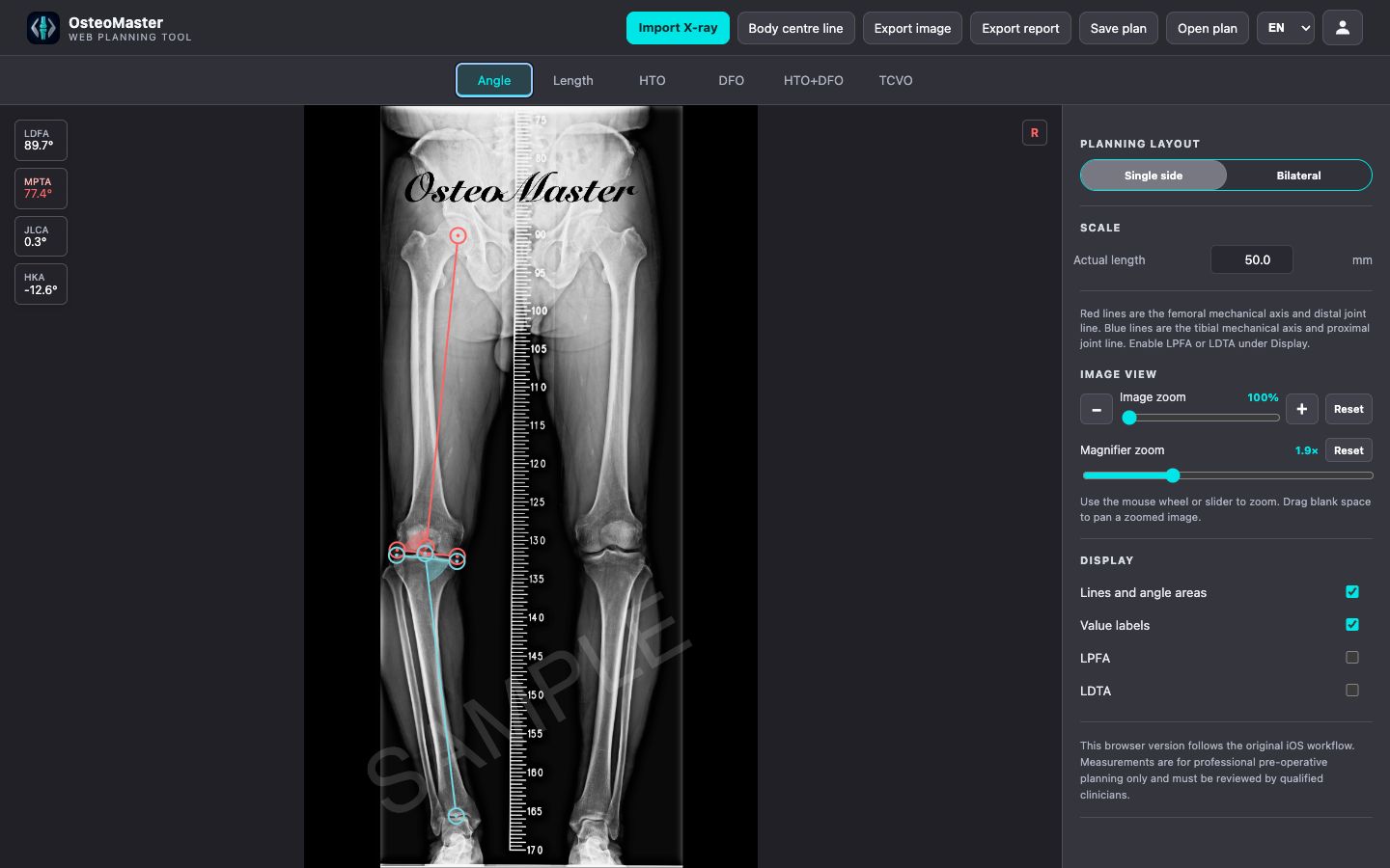 Real OsteoMaster desktop browser angle measurement workspace with abnormal alignment warnings