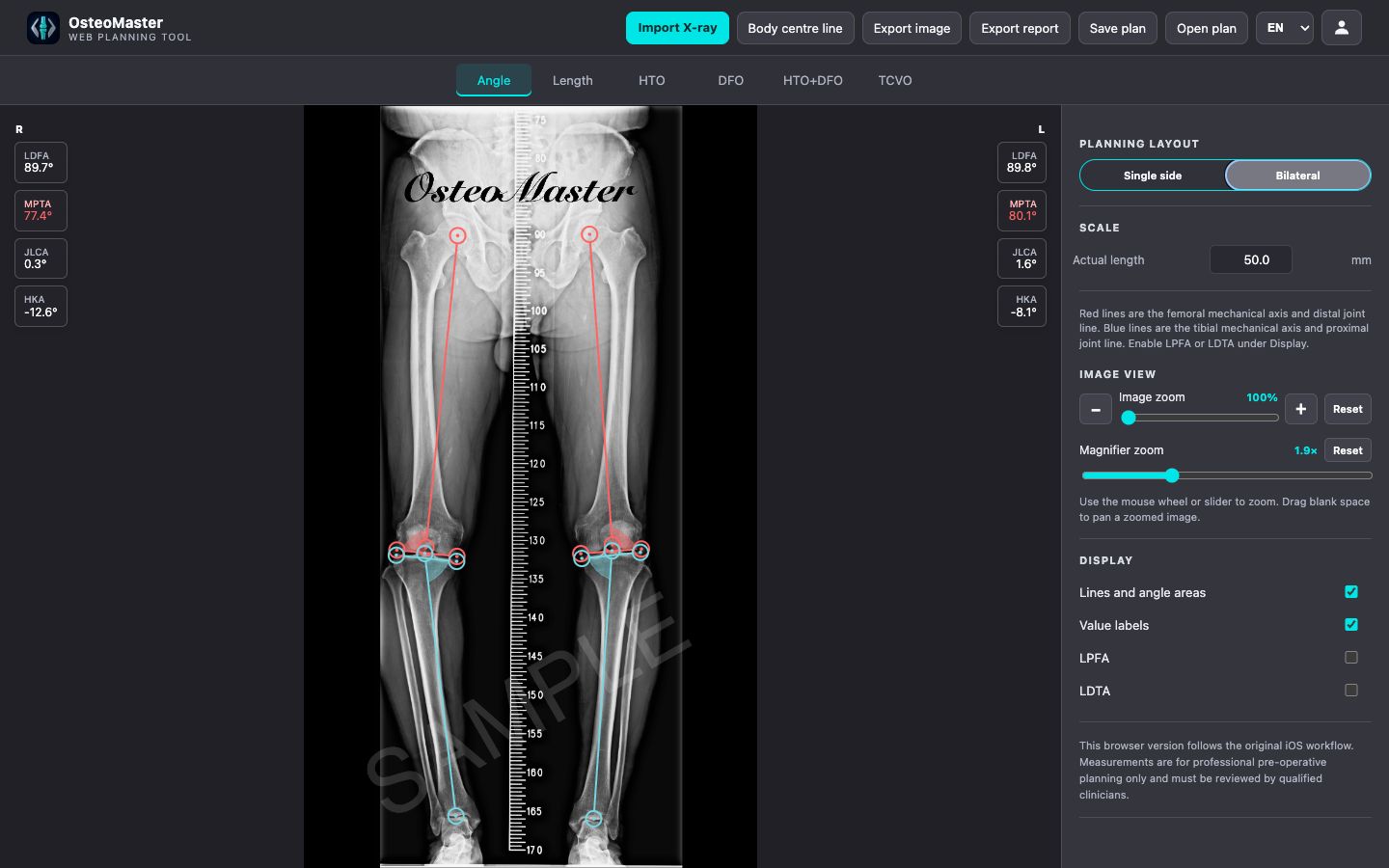 Real OsteoMaster desktop browser bilateral lower-limb planning workspace